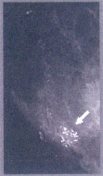¡ÅØèÁ¼ÅÖ¡ËÔ¹»Ù¹ microcalcification